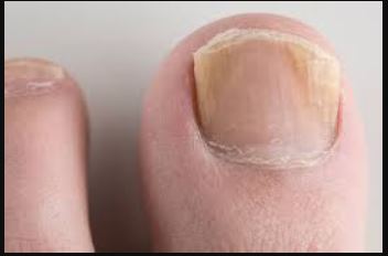 A Nail Infection Leads to Lyme Disease