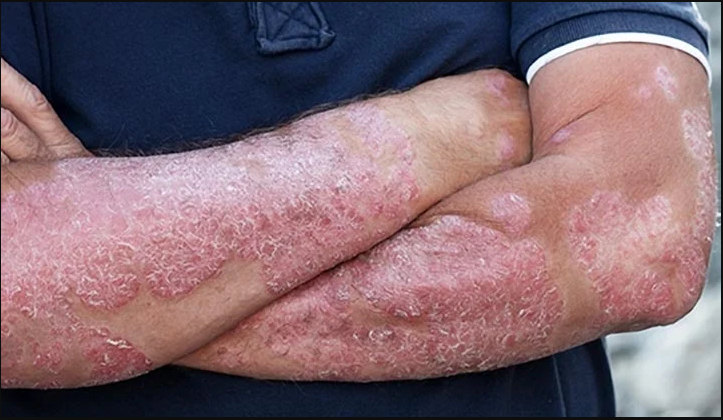 Adult Skin Infections