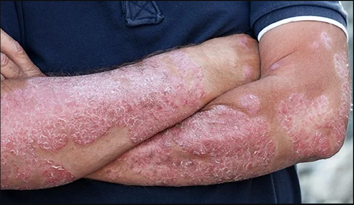 Older Adult Skin Infections Causes And Prevention 